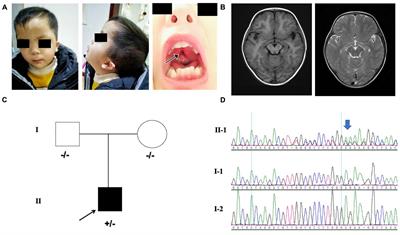 MN1 Neurodevelopmental Disease-Atypical Phenotype Due to a Novel Frameshift Variant in the MN1 Gene